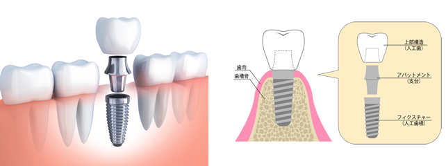 インプラント